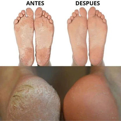 (30% DE DESCUENTO) Removedor de Callos Eléctrico – Pies suaves al instante