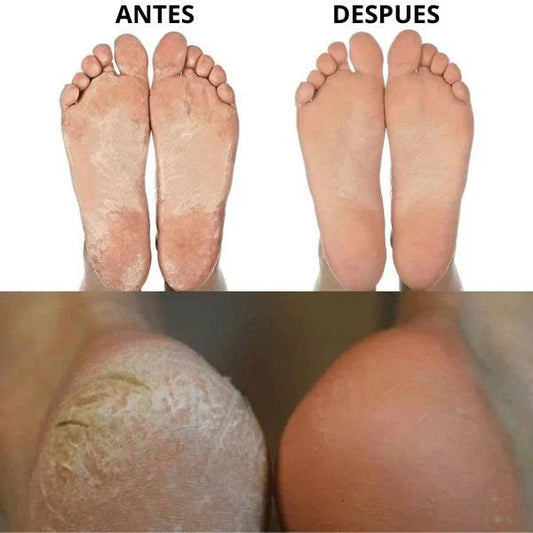 (30% DE DESCUENTO) Removedor de Callos Eléctrico – Pies suaves al instante